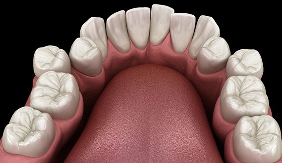 Illustration of crooked teeth
