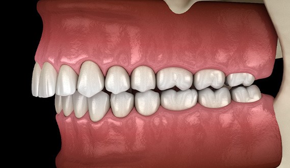 Illustration of overbite