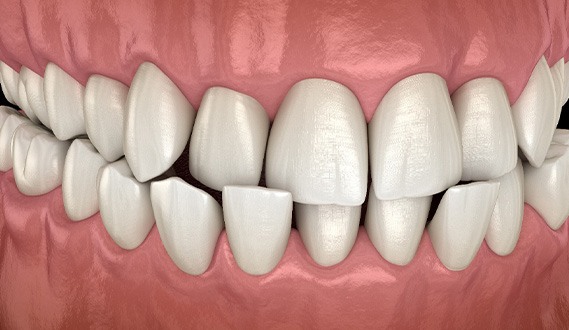 Illustration of a crossbite