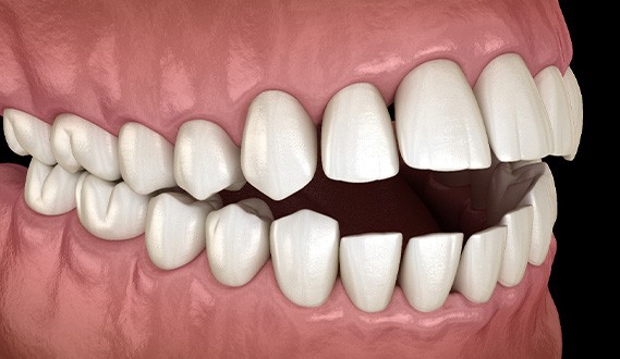 Illustration of an open bite