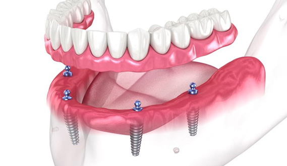 Illustration of implant dentures for lower arch