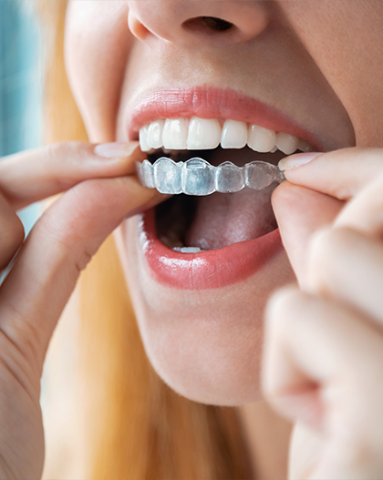 Woman holding Invisalign aligner, making thumbs-up gesture