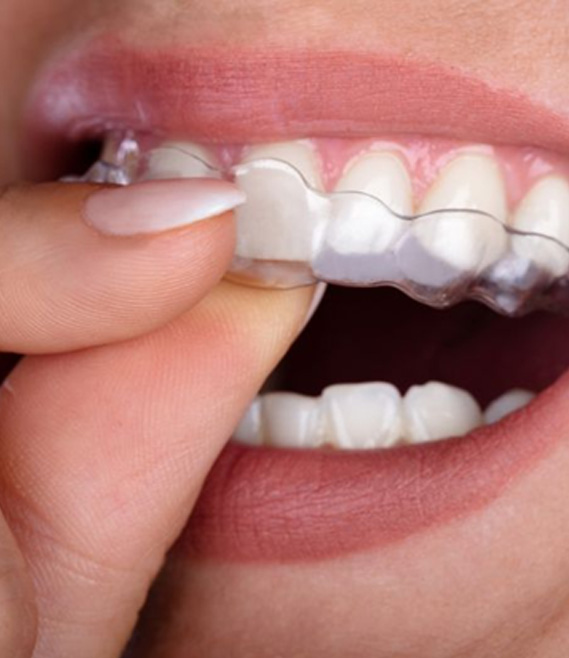 Close-up of woman’s mouth with Invisalign aligner