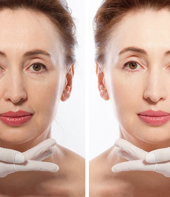  Before and after a woman receives dermal fillers