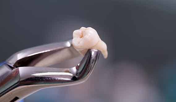 a pair of dental forceps holding a molar