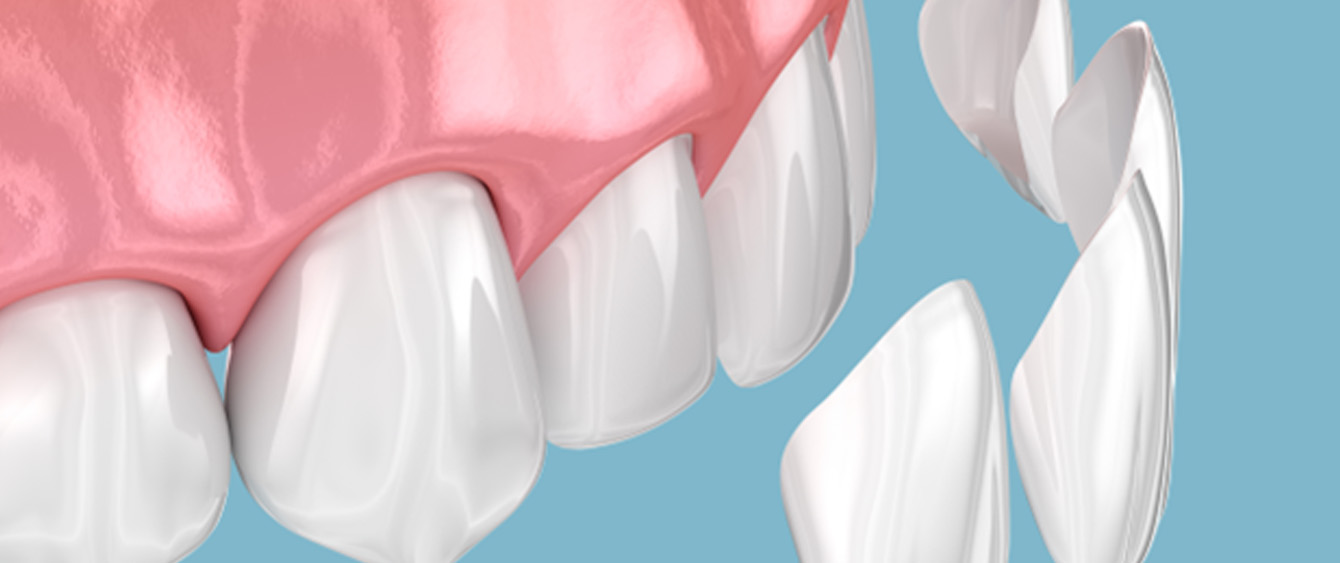 a graphic illustration showing how veneers fit atop teeth
