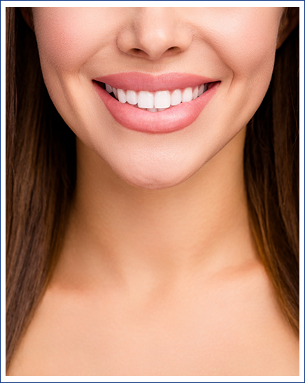 a graphic illustration showing how veneers fit atop teeth