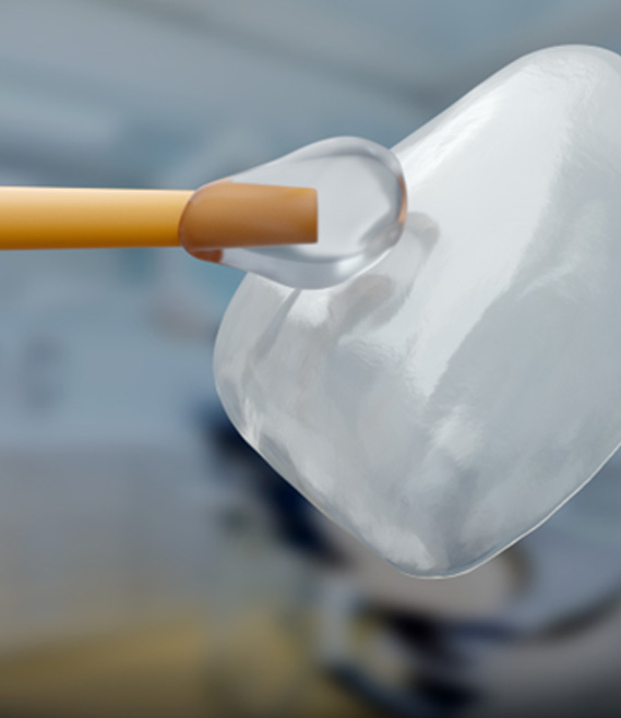 a close-up of a dental veneer